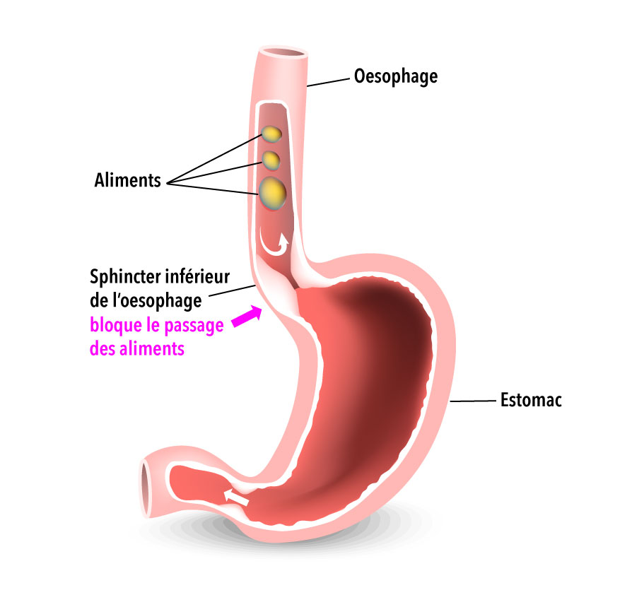 Dysphagie par Hypertonie du SIO