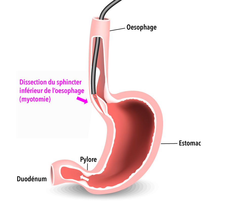 Incision du SIO (myotomie)