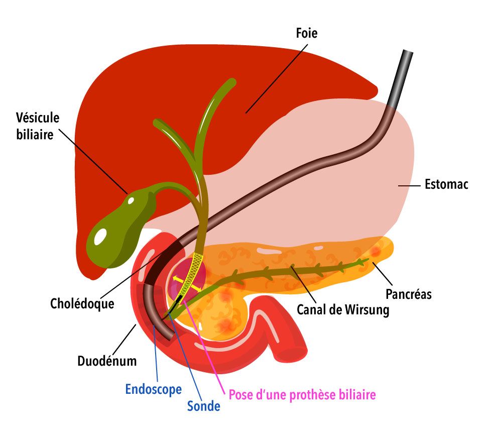 Cathétérisme endoscopique bilio-pancréatique qu'est-ce que c'est ?