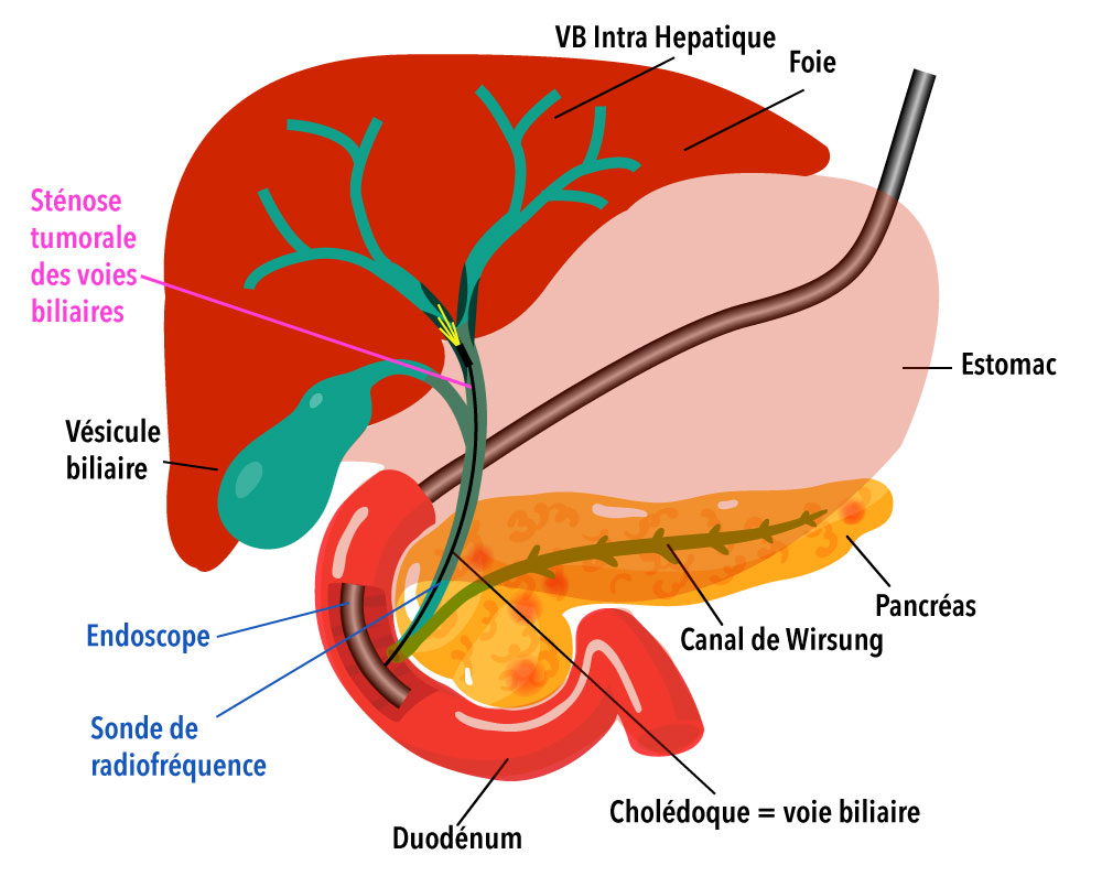 Les Voies Biliaires Et Les Voies HNDX