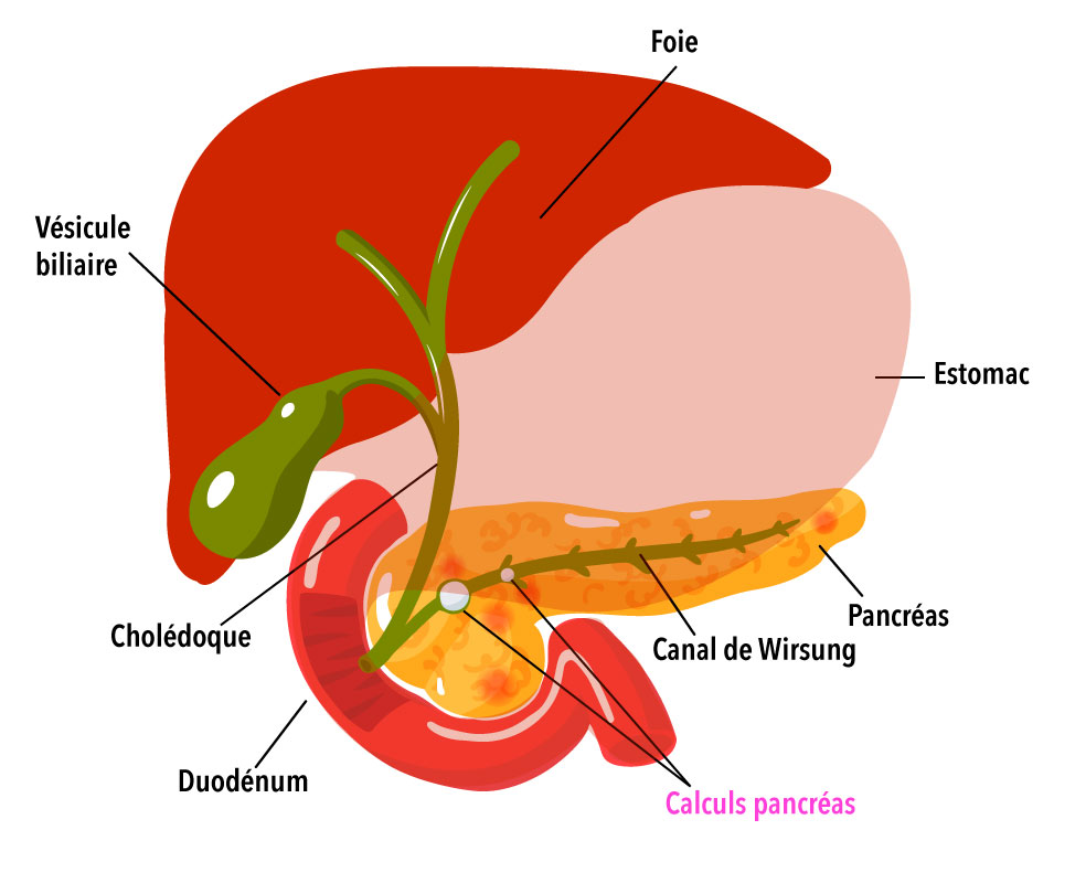 pancreatite-chronique-1