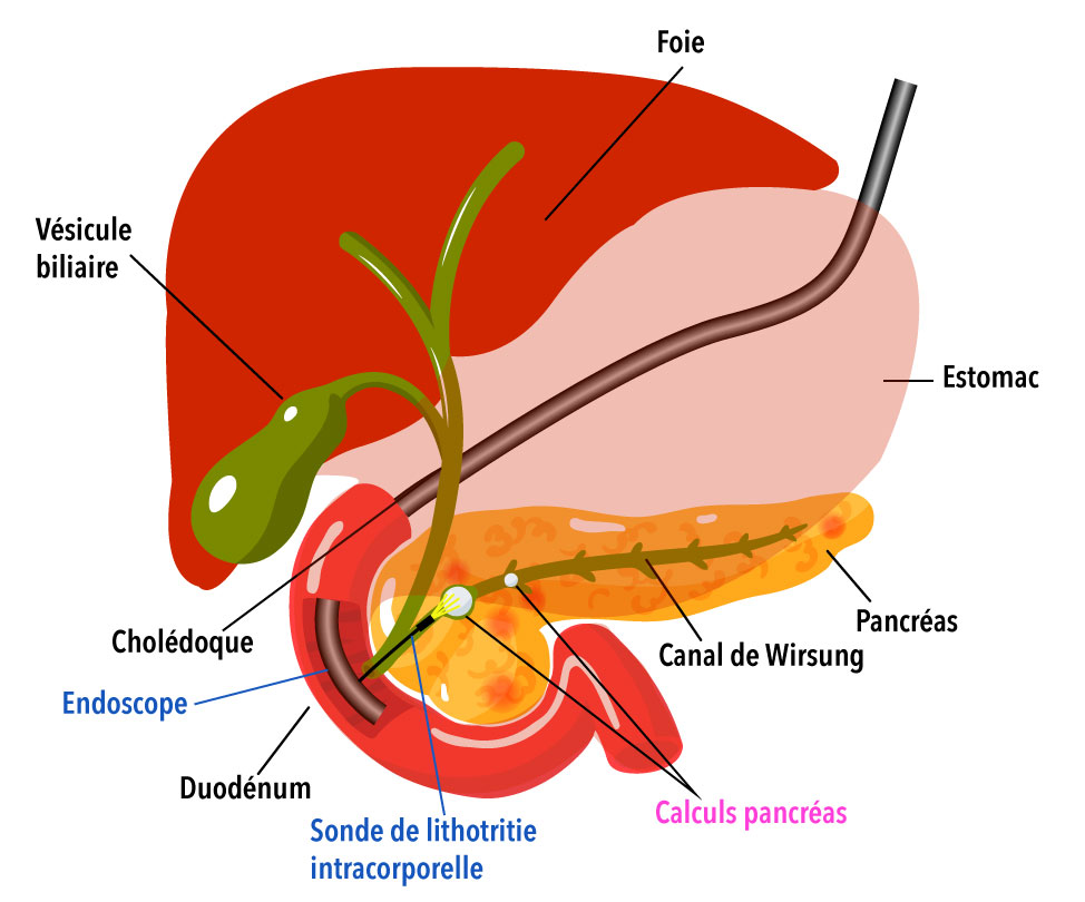 pancreatite-chronique-2