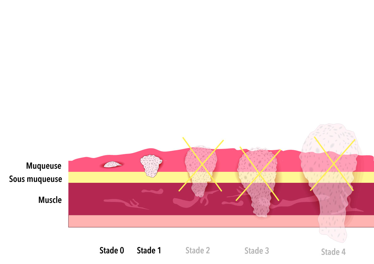 Indication de la dissection sous muqueuse pour les cancers superficiels du colon et du rectum