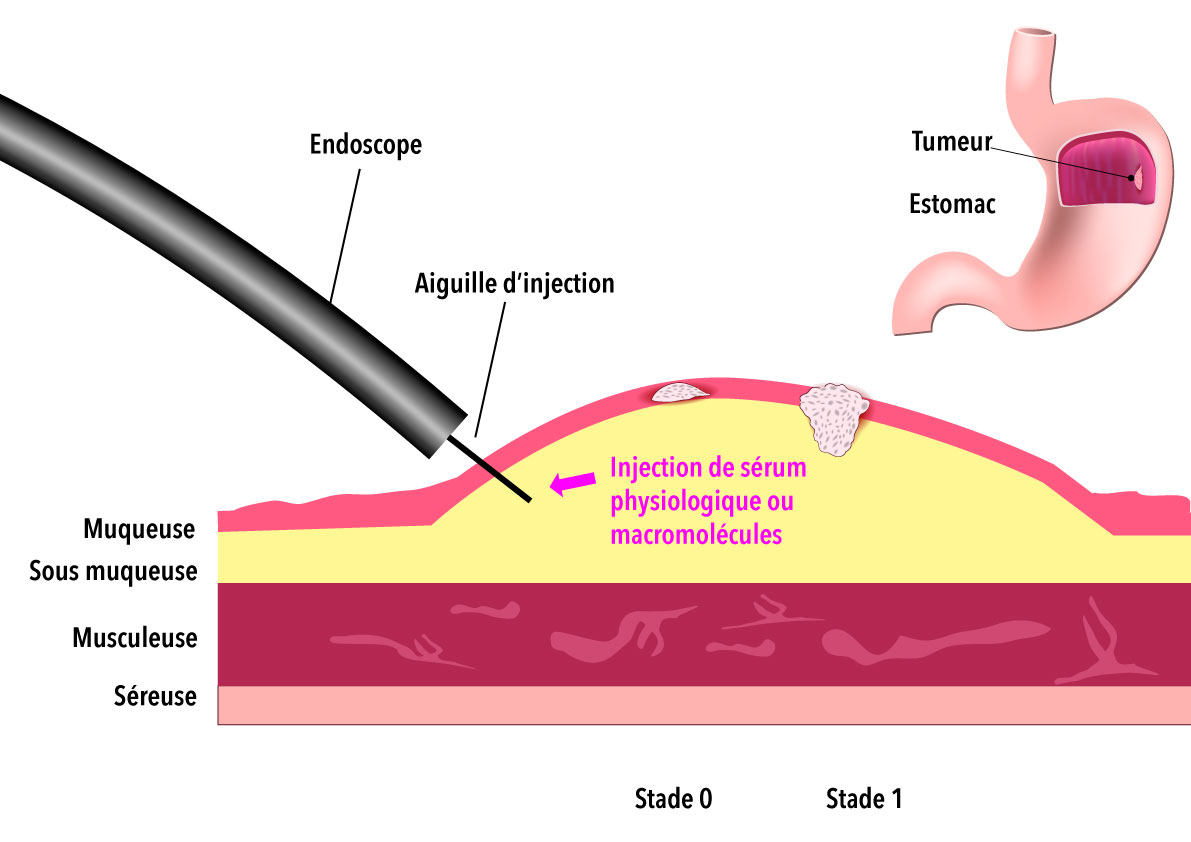 La coloscopie : une technique peu invasive diagnostique