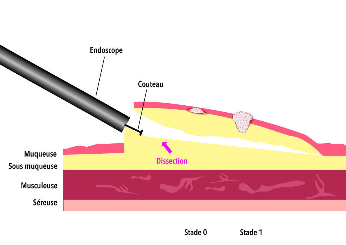 Dissection de la sous muqueuse