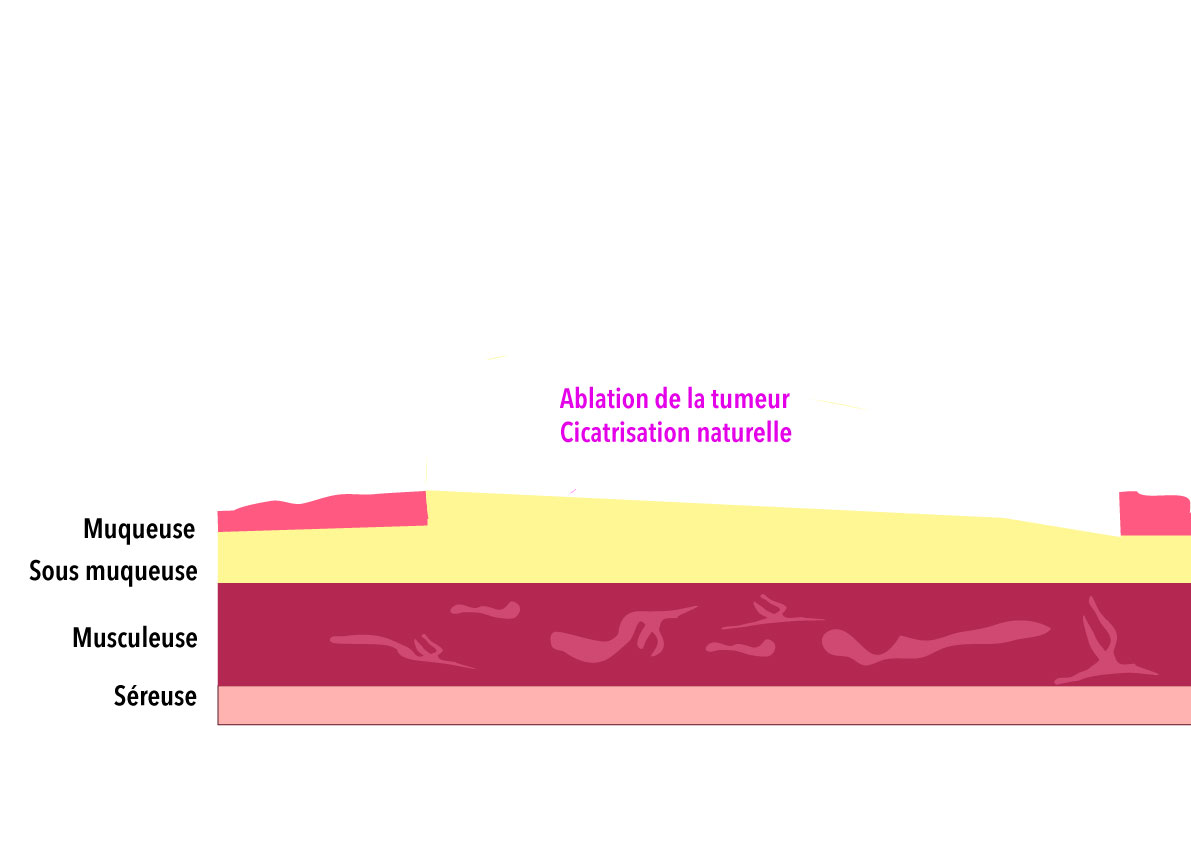 Ablation complète du cancer superficiel