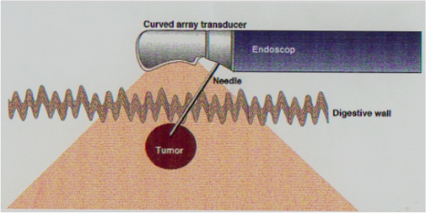 L echo endoscopie Digestive La Pointe Du Diagnostic Du Tube Digestif