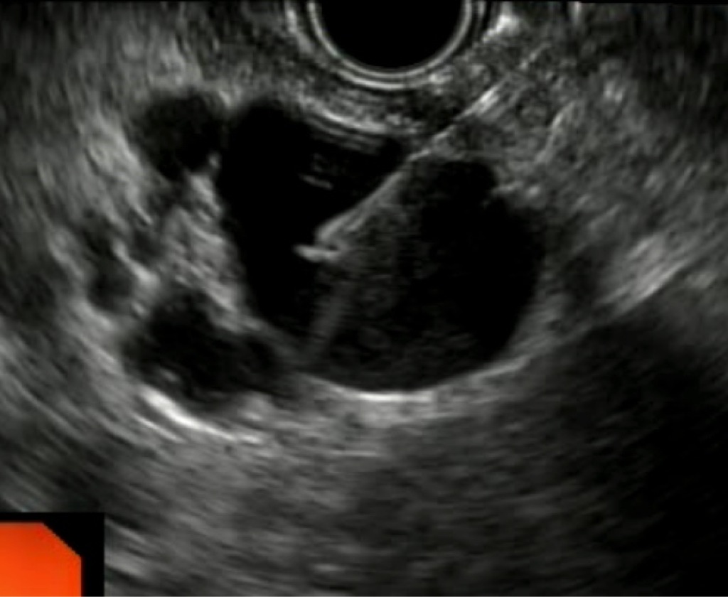 L echo endoscopie Digestive La Pointe Du Diagnostic Du Tube Digestif