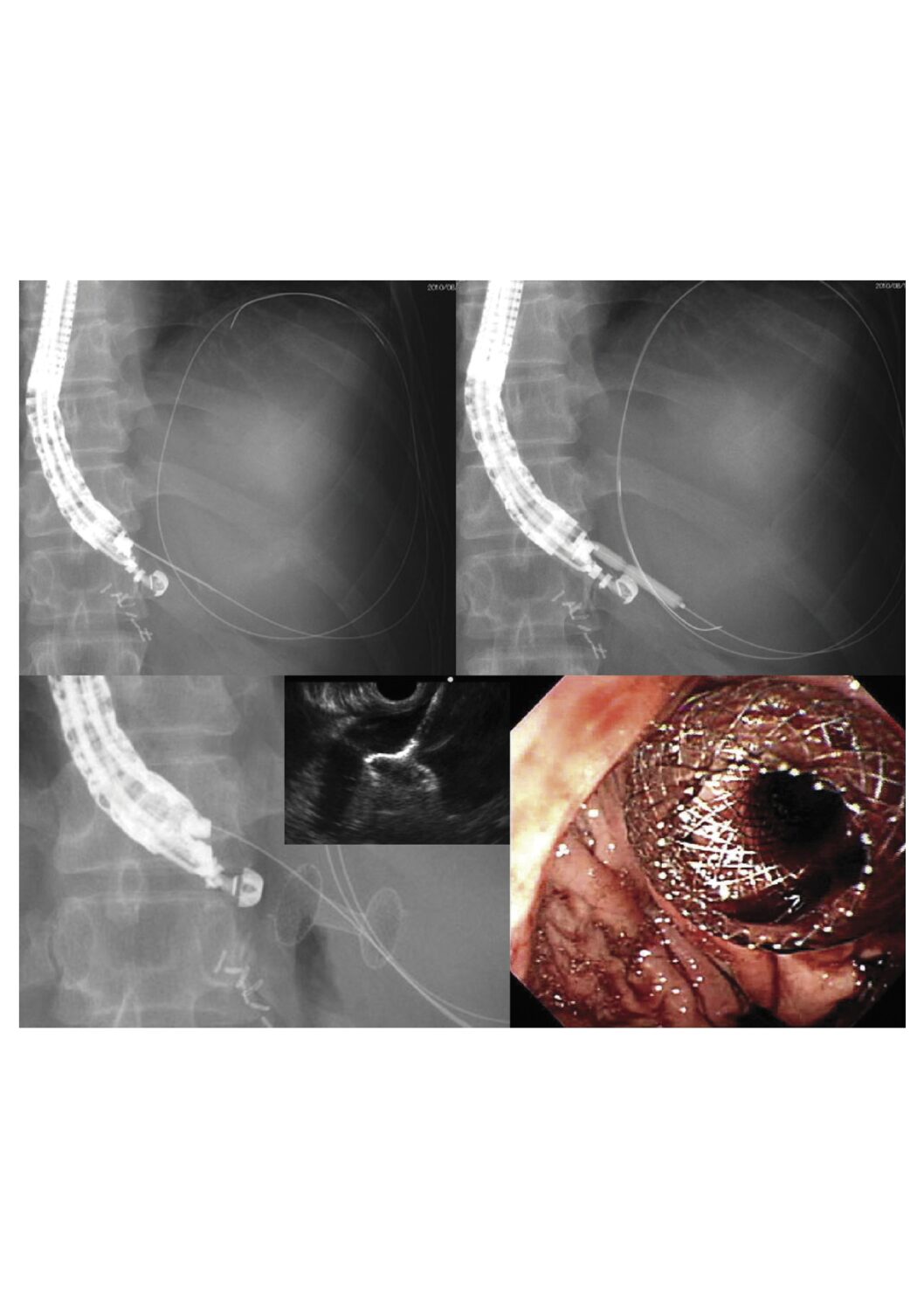 kystogastrostomie